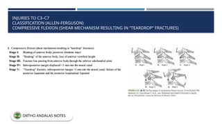 INJURIES TO C3–C7
CLASSIFICATION (ALLEN-FERGUSON)
COMPRESSIVE FLEXION (SHEAR MECHANISM RESULTING IN “TEARDROP” FRACTURES)
ORTHO ANDALAS NOTES
 