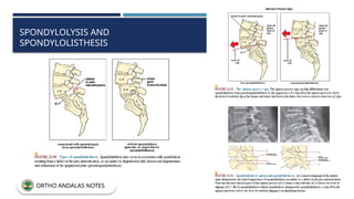 SPONDYLOLYSIS AND
SPONDYLOLISTHESIS
ORTHO ANDALAS NOTES
 