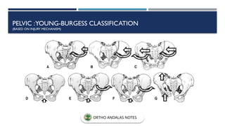 PELVIC :YOUNG-BURGESS CLASSIFICATION
(BASED ON INJURY MECHANISM)
ORTHO ANDALAS NOTES
 