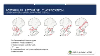 ACETABULAR : LETOURNEL CLASSIFICATION
BASED ON INVOLVEMENT OF ACETABULAR COLUMNS ANDWALLS
The five associated fracture types.
a Posterior column and wall.
b Transverse and posterior wall.
c T - t y p e .
d Anterior column and posterior hemitransverse.
e Both columns ORTHO ANDALAS NOTES
 