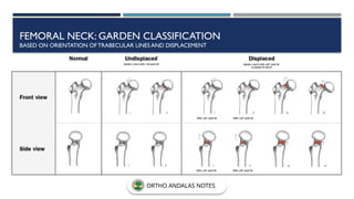 FEMORAL NECK: GARDEN CLASSIFICATION
BASED ON ORIENTATION OFTRABECULAR LINES AND DISPLACEMENT
ORTHO ANDALAS NOTES
 