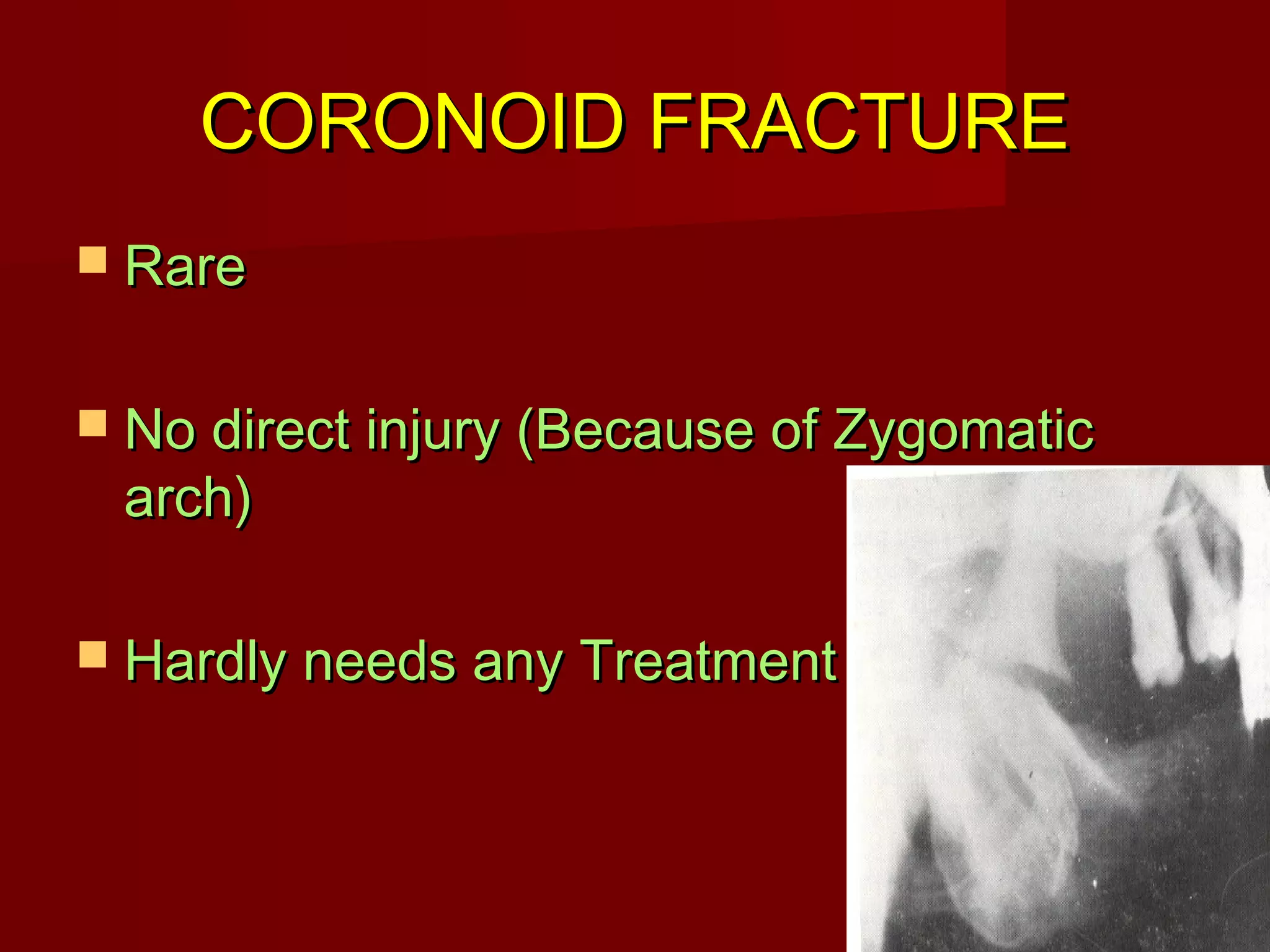 CCOORROONNOOIIDD FFRRAACCTTUURREE 
 RRaarree 
 NNoo ddiirreecctt iinnjjuurryy ((BBeeccaauussee ooff ZZyyggoommaattiicc 
aarrcchh)) 
 HHaarrddllyy nneeeeddss aannyy TTrreeaattmmeenntt 
 