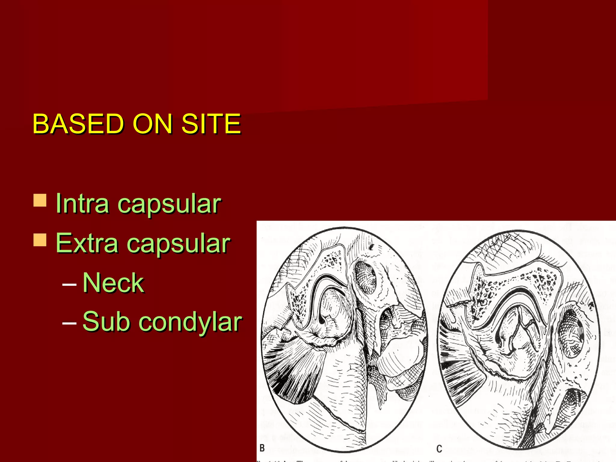 BBAASSEEDD OONN SSIITTEE 
 IInnttrraa ccaappssuullaarr 
 EExxttrraa ccaappssuullaarr 
– NNeecckk 
– SSuubb ccoonnddyyllaarr 
 