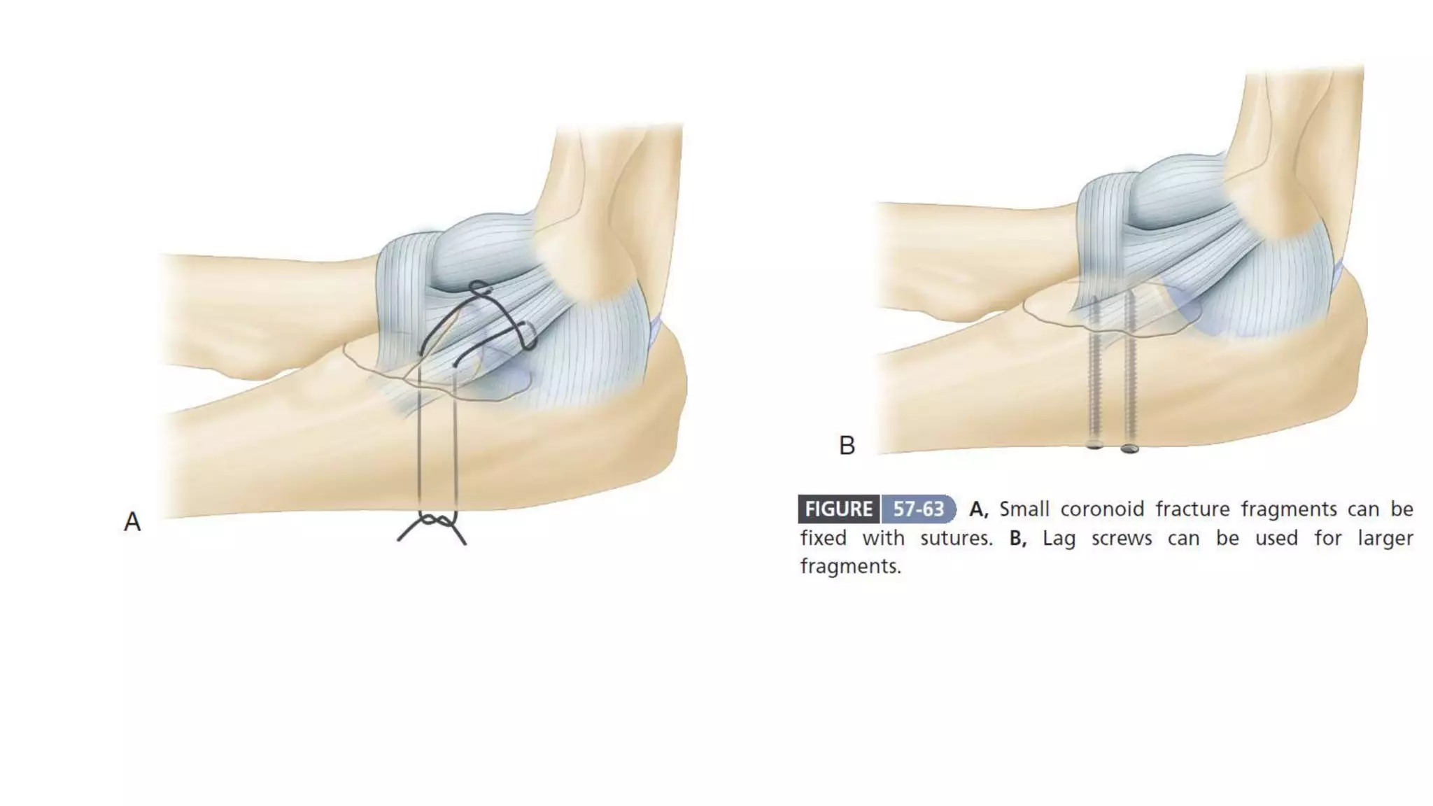 Fracture coronoid process of ulna