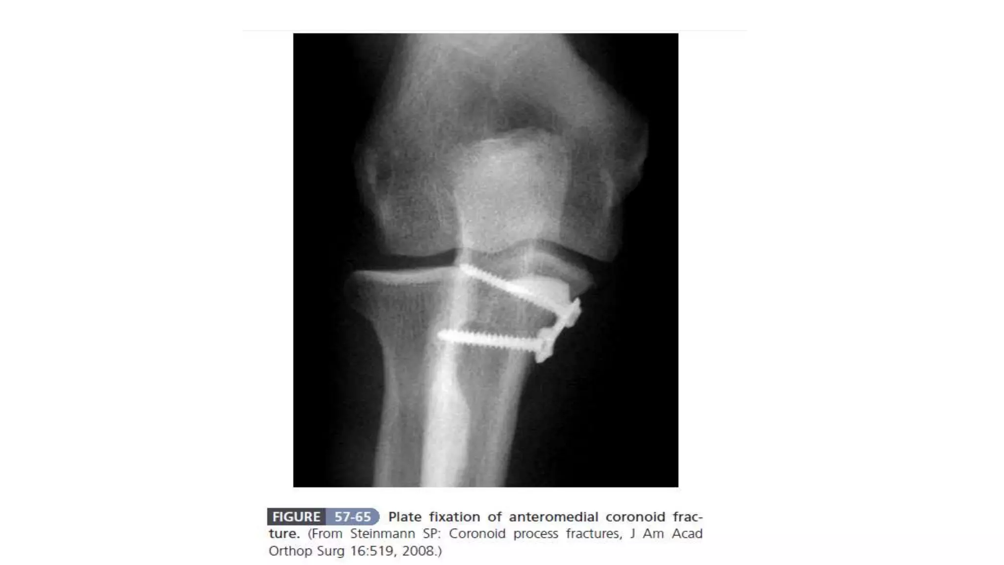 Fracture coronoid process of ulna