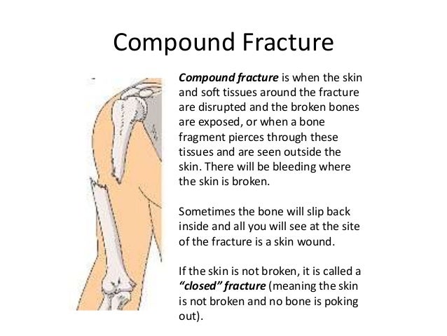 bone fracture meaning bone fracture meaning