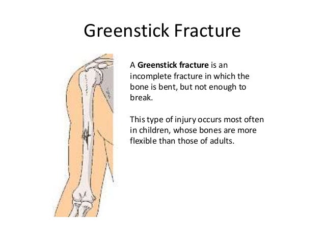 greenstick fracture