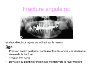 Fracture de la mandibule | PPT