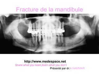 Fracture de la mandibule ,[object Object],[object Object],[object Object]
