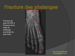 Fracture de 
type SLTER 3: 
Fracture de la 
base du 
phalange 
proximale du 
pied droit. 
Ayoub ELKADDOURI 
ayb.elk@gmail.com 
 