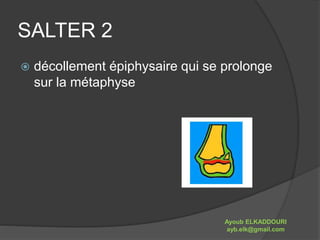 SALTER 2 
 décollement épiphysaire qui se prolonge 
sur la métaphyse 
Ayoub ELKADDOURI 
ayb.elk@gmail.com 
 