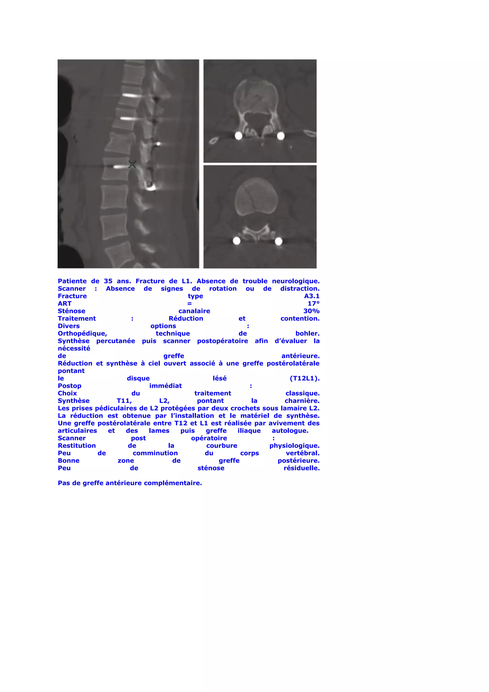 Patiente de 35 ans. Fracture de L1. Absence de trouble neurologique.
Scanner : Absence de signes de rotation ou de distraction.
Fracture                                type                                  A3.1
ART                                     =                                      17°
Sténose                              canalaire                               30%
Traitement             :          Réduction             et            contention.
Divers                       options                        :
Orthopédique,                 technique                 de                 bohler.
Synthèse percutanée puis scanner postopératoire afin d’évaluer la
nécessité
de                               greffe                               antérieure.
Réduction et synthèse à ciel ouvert associé à une greffe postérolatérale
pontant
le                   disque                     lésé                     (T12L1).
Postop                      immédiat                          :
Choix                  du                 traitement                    classique.
Synthèse           T11,        L2,         pontant             la      charnière.
Les prises pédiculaires de L2 protégées par deux crochets sous lamaire L2.
La réduction est obtenue par l’installation et le matériel de synthèse.
Une greffe postérolatérale entre T12 et L1 est réalisée par avivement des
articulaires    et   des    lames     puis    greffe    iliaque    autologue.
Scanner                post              opératoire                :
Restitution           de          la          courbure            physiologique.
Peu          de         comminution          du          corps          vertébral.
Bonne              zone            de             greffe             postérieure.
Peu                   de                   sténose                     résiduelle.

Pas de greffe antérieure complémentaire.
 