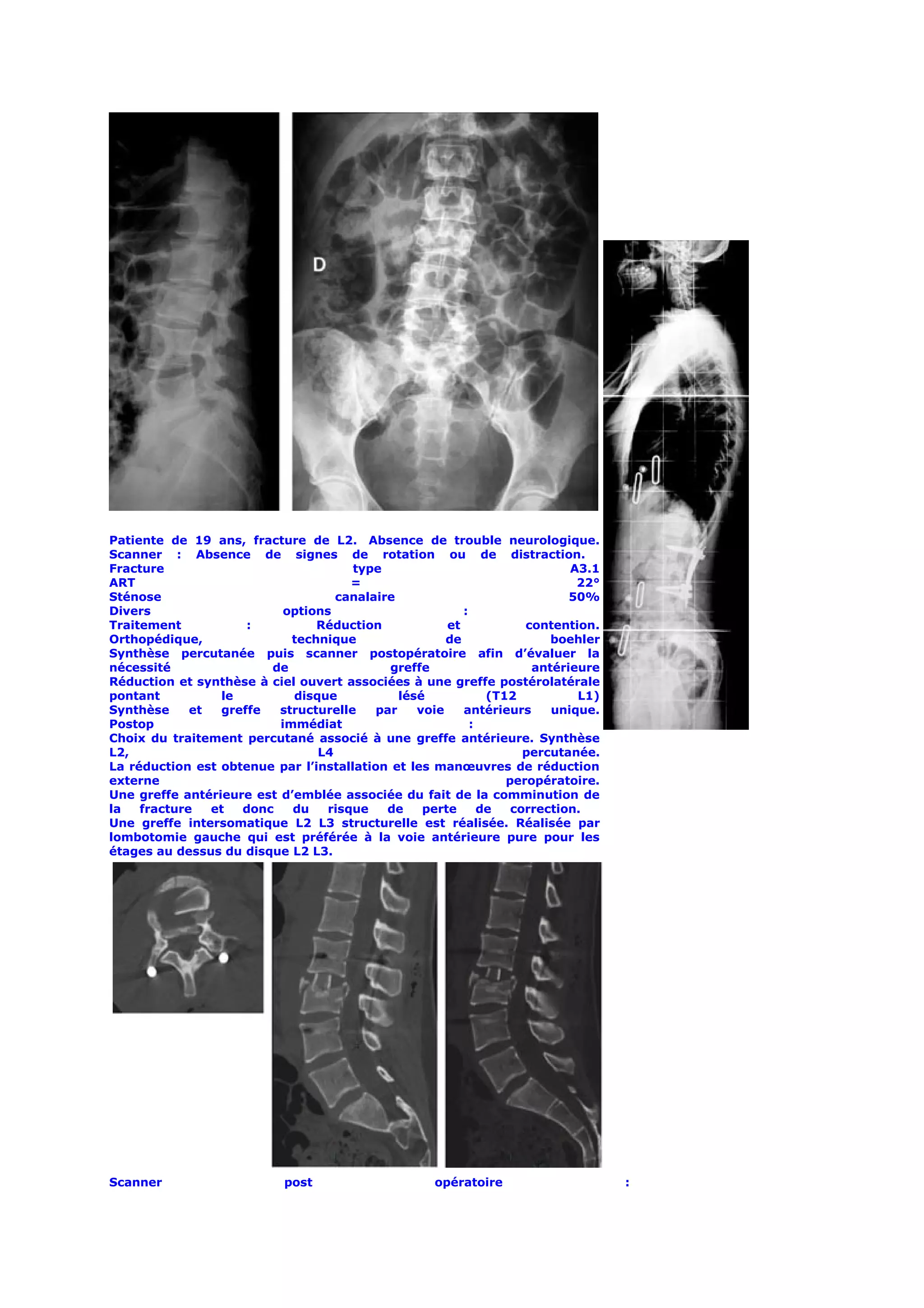 Patiente de 19 ans, fracture de L2. Absence de trouble neurologique.
Scanner : Absence de signes de rotation ou de distraction.
Fracture                              type                                 A3.1
ART                                   =                                     22°
Sténose                            canalaire                               50%
Divers                     options                       :
Traitement           :          Réduction             et            contention.
Orthopédique,               technique                 de                boehler
Synthèse percutanée puis scanner postopératoire afin d’évaluer la
nécessité               de                  greffe                   antérieure
Réduction et synthèse à ciel ouvert associées à une greffe postérolatérale
pontant          le         disque            lésé            (T12          L1)
Synthèse     et  greffe   structurelle    par    voie    antérieurs     unique.
Postop                    immédiat                         :
Choix du traitement percutané associé à une greffe antérieure. Synthèse
L2,                             L4                                  percutanée.
La réduction est obtenue par l’installation et les manœuvres de réduction
externe                                                          peropératoire.
Une greffe antérieure est d’emblée associée du fait de la comminution de
la   fracture   et  donc    du    risque   de     perte      de   correction.
Une greffe intersomatique L2 L3 structurelle est réalisée. Réalisée par
lombotomie gauche qui est préférée à la voie antérieure pure pour les
étages au dessus du disque L2 L3.




Scanner                     post                    opératoire                    :
 