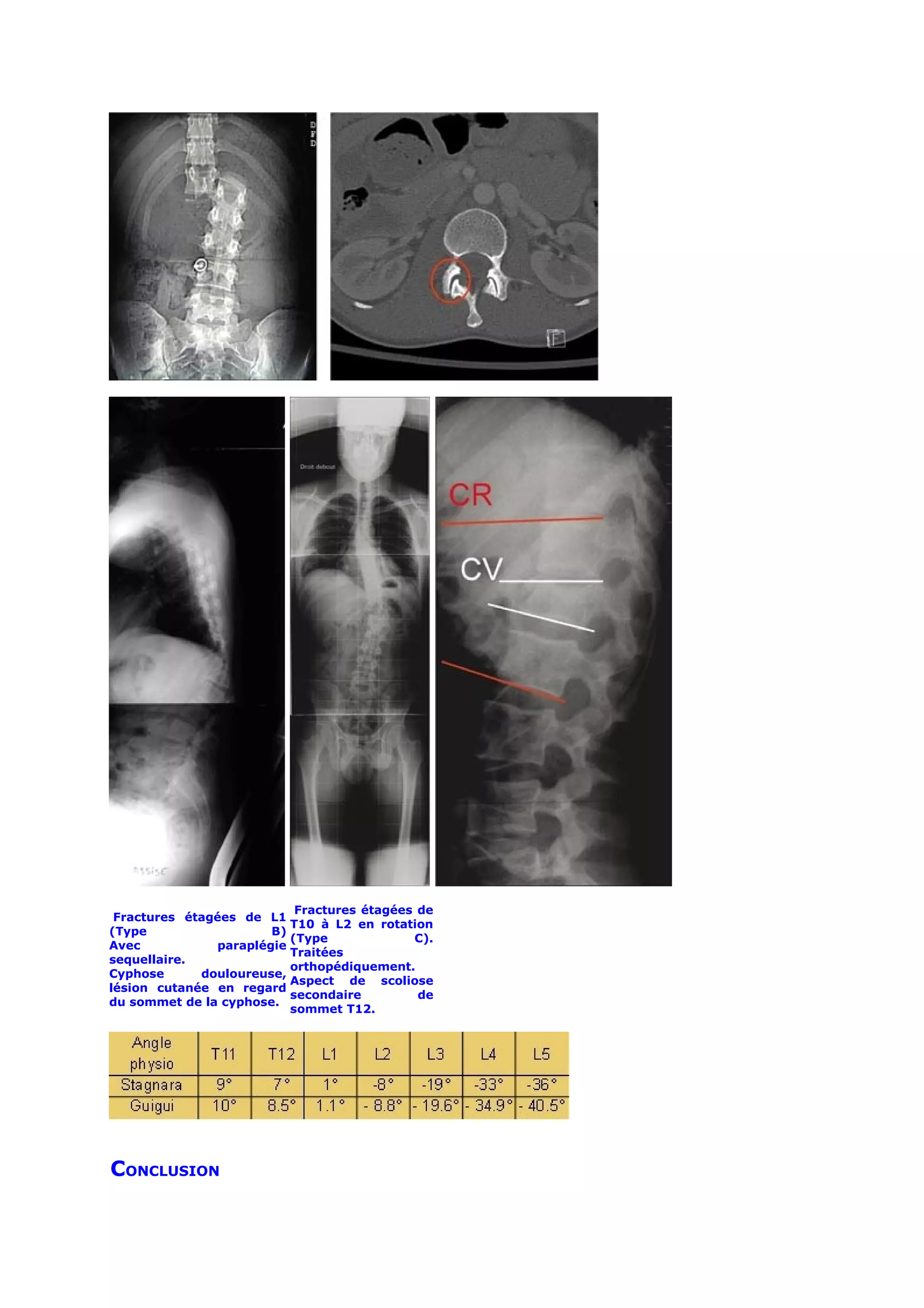 Fractures étagées de
 Fractures étagées de L1
                          T10 à L2 en rotation
(Type                  B)
                          (Type             C).
Avec           paraplégie
                          Traitées
sequellaire.
                          orthopédiquement.
Cyphose      douloureuse,
                          Aspect de scoliose
lésion cutanée en regard
                          secondaire         de
du sommet de la cyphose.
                          sommet T12.




CONCLUSION
 