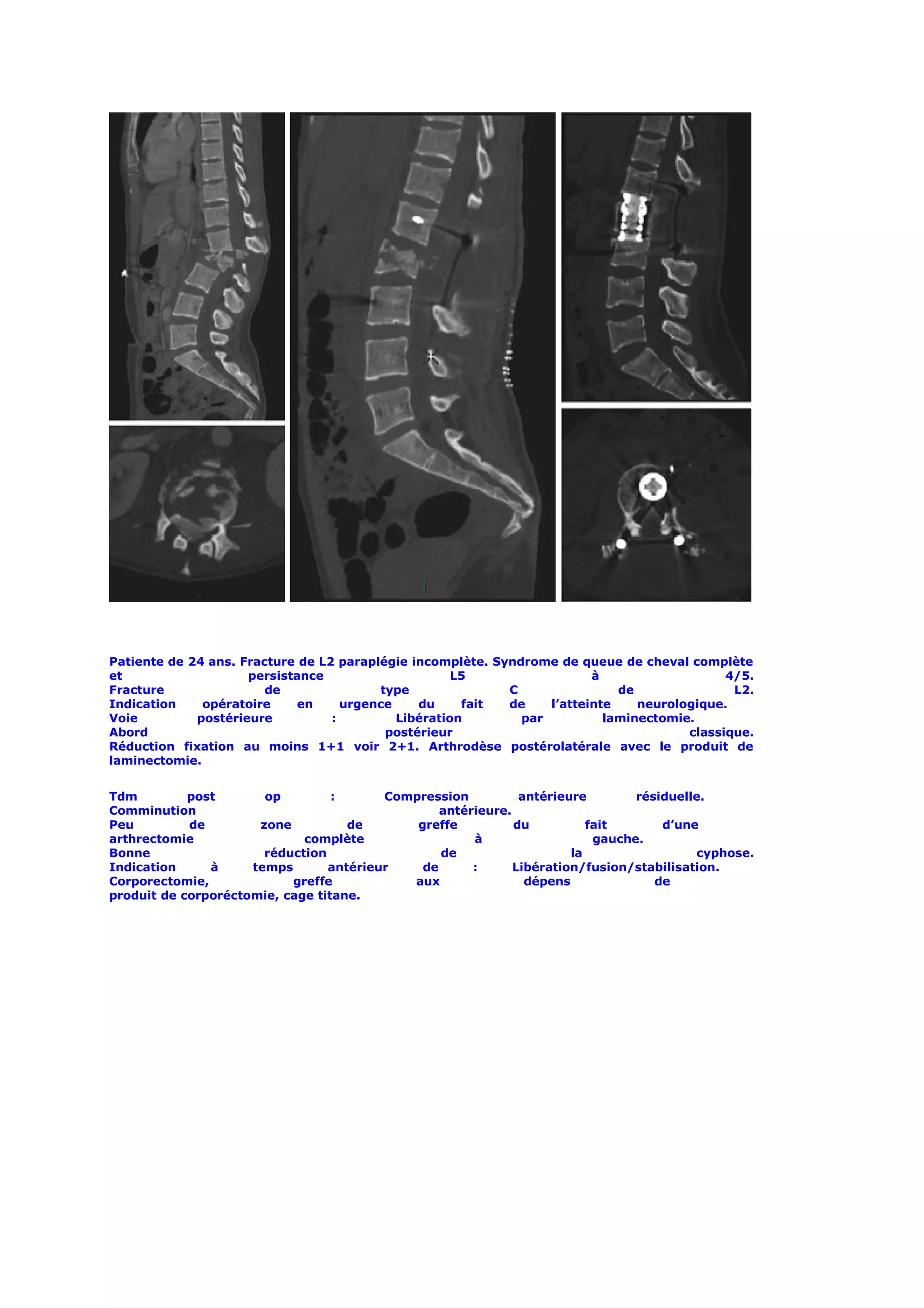 Patiente de 24 ans. Fracture de L2 paraplégie incomplète. Syndrome de queue de cheval complète
et                   persistance                     L5                  à                   4/5.
Fracture                de               type               C                de               L2.
Indication    opératoire     en     urgence    du     fait  de    l’atteinte    neurologique.
Voie         postérieure          :         Libération        par          laminectomie.
Abord                                     postérieur                                   classique.
Réduction fixation au moins 1+1 voir 2+1. Arthrodèse postérolatérale avec le produit de
laminectomie.


Tdm         post       op         :      Compression          antérieure        résiduelle.
Comminution                                      antérieure.
Peu         de        zone          de       greffe          du          fait       d’une
arthrectomie                 complète                 à                   gauche.
Bonne                  réduction                 de                   la                 cyphose.
Indication     à     temps       antérieur    de      :      Libération/fusion/stabilisation.
Corporectomie,             greffe           aux                dépens              de
produit de corporéctomie, cage titane.
 