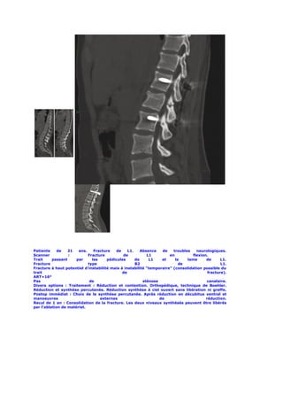 Patiente     de   21   ans.    Fracture   de     L1.    Absence   de    troubles   neurologiques.
Scanner           :         Fracture          de           L1         en         flexion.
Trait     passant     par     les     pédicules      de     L1    et     la    lame     de      L1.
Fracture                    type                     B2                    de                   L1.
Fracture à haut potentiel d’instabilité mais à instabilité “temporaire” (consolidation possible du
trait                                         de                                         fracture).
ART=16°
Pas                          de                          sténose                        canalaire.
Divers options : Traitement : Réduction et contention. Orthopédique, technique de Boehler.
Réduction et synthèse percutanée. Réduction synthèse à ciel ouvert sans libération ni greffe.
Postop immédiat : Choix de la synthèse percutanée. Après réduction en décubitus ventral et
manoeuvres                        externes                       de                     réduction.
Recul de 1 an : Consolidation de la fracture. Les deux niveaux synthésés peuvent être libérés
par l’ablation de matériel.
 