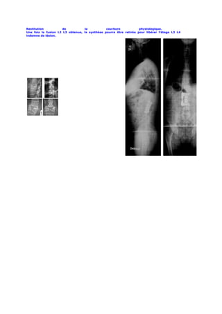 Restitution          de           la           courbure            physiologique.
Une fois la fusion L2 L3 obtenue, la synthèse pourra être retirée pour libérer l’étage L3 L4
indemne de lésion.
 