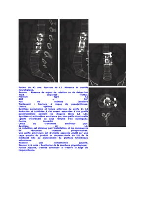 Patient de 42 ans. Fracture de L2. Absence de trouble
neurologique.
Scanner : Absence de signes de rotation ou de distraction
Trait                      corporéal                           frontal.
Fracture                           type                             A2
ART                              =                                 20°
Pas              de                 sténose                  canalaire
Traitement    :   fracture     à     risque    de       pseudarthrose.
Divers                  options                     :
Synthèse percutanée et temps antérieur de greffe L1 L3
Réduction et synthèse à ciel ouvert associées à une greffe
postérolatérale   pontant      les     disques    lésés     (L1   L3).
Synthèse et arthrodèse antérieure par une greffe structurelle
(greffe tricorticale ou cage remplie d’os autologue).
Postop                 immédiat                       :
Choix        du          traitement           antérieur           pur.
Synthèse                             L2,                           L4.
La réduction est obtenue par l’installation et les manœuvres
de         réduction            externes               peropératoires.
Une greffe antérieure est d’emblée associée plutôt par une
cage remplie du produit de corporectomie du fait de la
morbidité liée au prelèvement de greffons tricorticaux
volumineux.
Réalisée           par              lombotomie                gauche.
Scanner à 6 mois : Restitution de la courbure physiologique.
Fusion acquise, travées continues à travers la cage de
corporectomie.
 