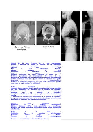 Patient     de    43    ans.     Fracture    de    L2    non    neurologique.
Scanner : Absence de signes de rotation ou de distraction
Fracture                        corporéale                       comminutive.
Fracture                                type                              A3.3
ART              =           37°.             Déformation             frontale.
Sténose                   canalaire                   <                   30%
Traitement            :            Réduction           et           contention
Divers                                 options                                :
Synthèse      percutanée   et     temps    antérieur   de    greffe   L1   L3.
Synthèse      percutanée     et     cimentoplastie    du    corps     de   L2.
Réduction et synthèse à ciel ouvert associées à une greffe postérolatérale
pontant les disques lésés (L1 L3) puis scanner en prévision d’une greffe
antérieure                                                   complémentaire.
Synthèse et arthrodèse antérieure par une greffe structurelle (greffe
tricorticale ou cage remplie d’os autologue).


Postop                     immédiat                      :
Nécessité d’une réduction dans le plan frontal et sagittal, mieux contrôlée
par voie postérieure en réduisant sur le matériel de synthèse.
Choix                 du                  traitement             classique.
Synthèse          T12,        L3,          pontant        la     charnière.
Les prises pédiculaires de L3 sont protégées par deux crochets sous
lamaire                                                                 L3.
La réduction est obtenue par l’installation et le matériel de synthèse.
Une greffe postéro latérale entre L1 et L3 est réalisée par avivement des
articulaires et des lames puis greffe iliaque autologue.


Scanner                 post               opératoire               :
Restitution          de      la        courbure         physiologique
Sténose     résiduelle  50%,    mais   possibilité   de  remodelage.
Nécessité de greffe antérieure structurelle malgré greffe postérieure
satisfaisante.

Radio                 à                6                 mois                :
Restitution          de          la         courbure            physiologique.
Réduction             pérenne             dans            le            temps.
Absence                de               troubles                neurologiques.

Scanner post opératoire d’un autre choix thérapeutique :
 