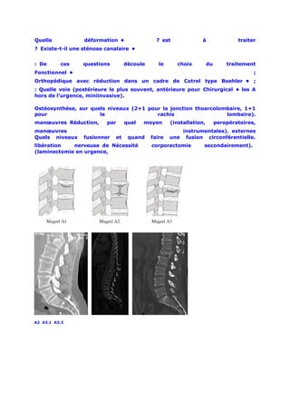 Quelle            déformation •                  ? est             à                 traiter
? Existe-t-il une sténose canalaire •


: De      ces    questions           découle      le     choix          du       traitement
Fonctionnel •                                                                              ;
Orthopédique avec réduction dans un cadre de Cotrel type Boehler • ;
: Quelle voie (postérieure le plus souvent, antérieure pour Chirurgical • les A
hors de l’urgence, miniinvasive).

Ostéosynthèse, sur quels niveaux (2+1 pour la jonction thoarcolombaire, 1+1
pour                  le                 rachis                  lombaire).
manœuvres Réduction,      par        quel   moyen      (installation,        peropératoires,
manœuvres                                                  instrumentales). externes
Quels niveaux     fusionner     et    quand    faire   une fusion circonférentielle.
libération   nerveuse de Nécessité             corporectomie        secondairement). 
(laminectomie en urgence,




A2 A3.1 A3.3
 