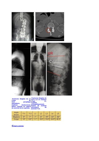 Fractures étagées de
 Fractures étagées de L1
                          T10 à L2 en rotation
(Type                  B)
                          (Type             C).
Avec           paraplégie
                          Traitées
sequellaire.
                          orthopédiquement.
Cyphose      douloureuse,
                          Aspect de scoliose
lésion cutanée en regard
                          secondaire         de
du sommet de la cyphose.
                          sommet T12.




CONCLUSION
 