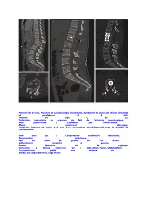 Patiente de 24 ans. Fracture de L2 paraplégie incomplète. Syndrome de queue de cheval complète
et                   persistance                     L5                  à                   4/5.
Fracture                de               type               C                de               L2.
Indication    opératoire     en     urgence    du     fait  de    l’atteinte    neurologique.
Voie         postérieure          :         Libération        par          laminectomie.
Abord                                     postérieur                                   classique.
Réduction fixation au moins 1+1 voir 2+1. Arthrodèse postérolatérale avec le produit de
laminectomie.


Tdm         post       op         :      Compression          antérieure        résiduelle.
Comminution                                      antérieure.
Peu         de        zone          de       greffe          du          fait       d’une
arthrectomie                 complète                 à                   gauche.
Bonne                  réduction                 de                   la                 cyphose.
Indication     à     temps       antérieur    de      :      Libération/fusion/stabilisation.
Corporectomie,             greffe           aux                dépens              de
produit de corporéctomie, cage titane.
 