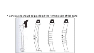 Fracture Fixation Techniques.pptx