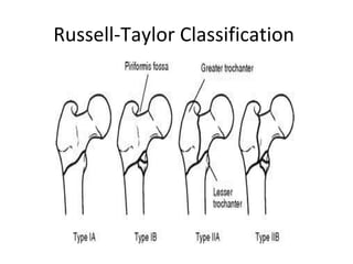 Russell-Taylor Classification
 