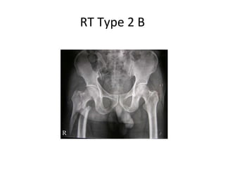 RT Type 2 B
 