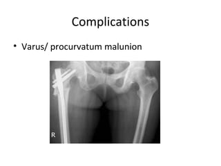 Complications
• Varus/ procurvatum malunion
 