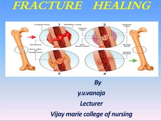 FRACTURE HEALING
By
y.v.vanaja
Lecturer
Vijay marie college of nursing
 