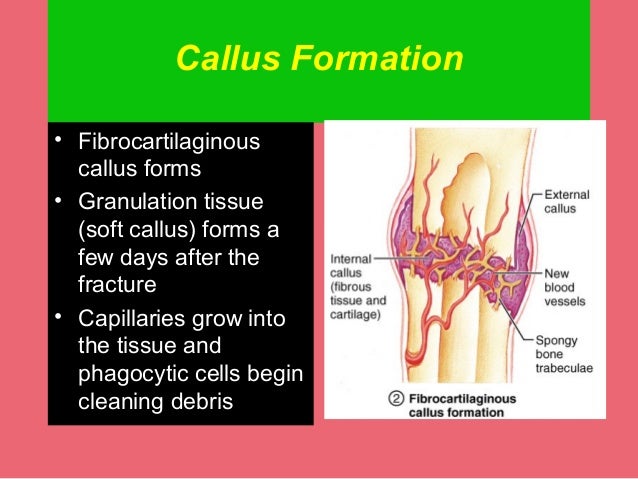 fracture healing fracture healing, Muscles