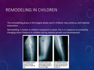REMODELING IN CHILDREN
The remodelling phase is the longest phase and in children may continue until skeletal
maturation.
Remodelling is better in children compared to adult, this is in response to constantly
changing stress Patterns in children during skeletal growth and development.
 