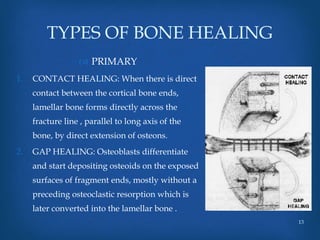 Fracture Healing.pptx