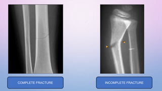 Incomplete Break fracture healing.pptx hdjdcehbmjncksjdcf | PPTX