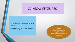 CLINICAL FEATURES
• Persistant pain at fracture
site
• Instability of fracture site X-RAY
-Visible Fracture line
-Very little callus
formation or periosteal
reaction
 