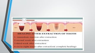 FRACTURE, FRACTURE HEALING , HEALING SOCKET