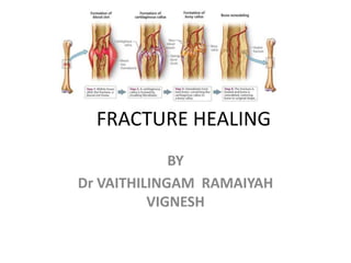 FRACTURE HEALING
BY
Dr VAITHILINGAM RAMAIYAH
VIGNESH
 