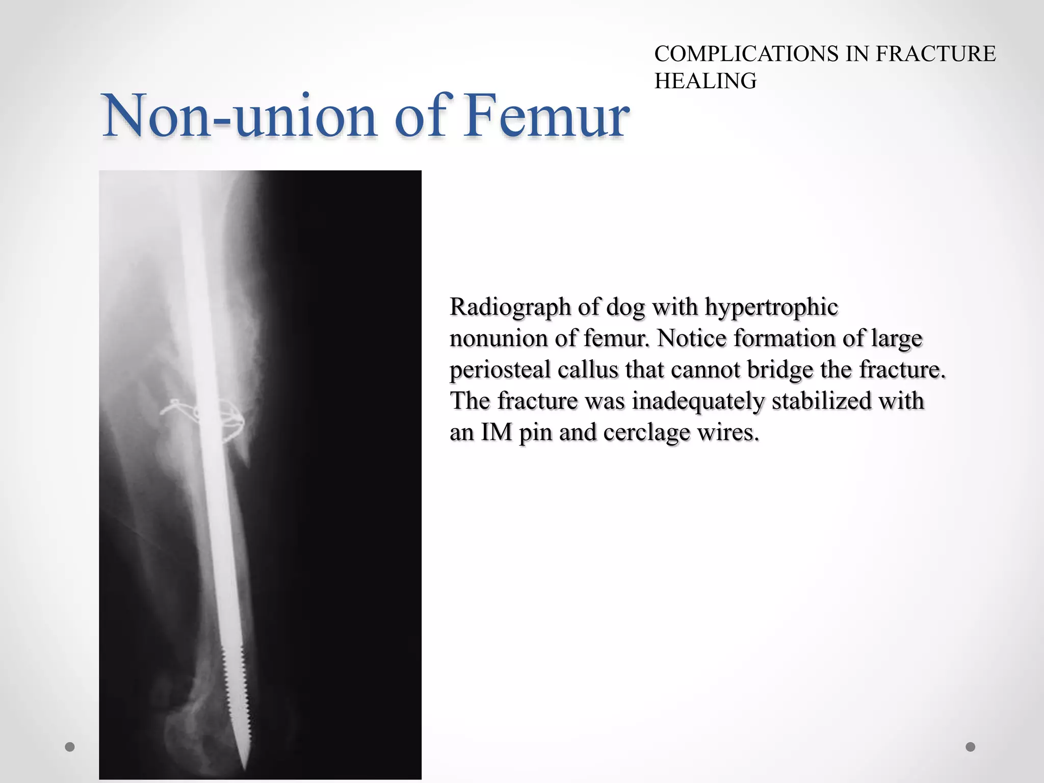 Fracture Healing Complication Factors Promotes The Fracture Healing fracture-healing-complication-factors-promotes-the-fracture-healing