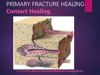 Contact Healing
PRIMARY FRACTURE HEALING
Franz Haerle, Atlas of Craniomaxillofacial Osteosynthesis
 