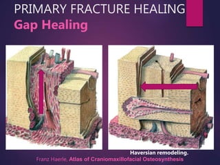 Gap Healing
PRIMARY FRACTURE HEALING
Haversian remodeling.
Franz Haerle, Atlas of Craniomaxillofacial Osteosynthesis
 