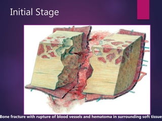 Initial Stage
Bone fracture with rupture of blood vessels and hematoma in surrounding soft tissues
 