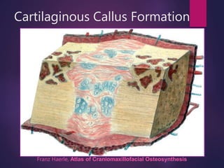 Cartilaginous Callus Formation
Franz Haerle, Atlas of Craniomaxillofacial Osteosynthesis
 