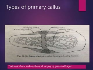 Types of primary callus
Textbook of oral and maxillofacial surgery by gustav o Kruger.
 