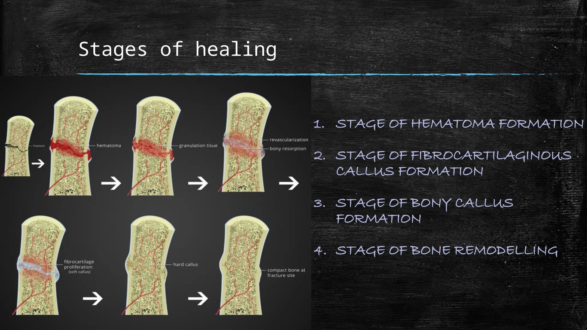 Fracture healing stages and complications | PPTX