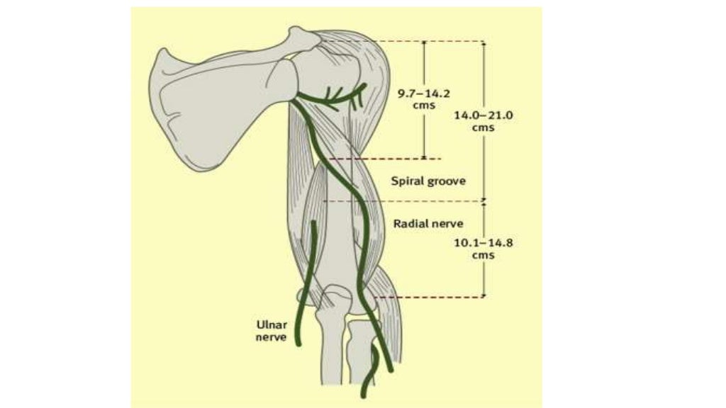 Fracture humerus with radial nerve injury