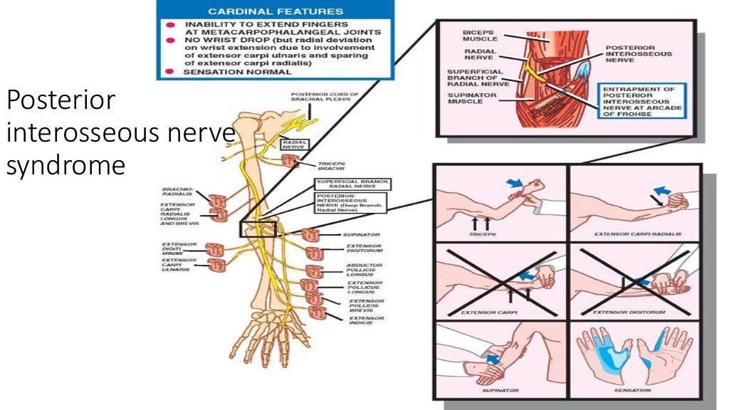 Fracture humerus with radial nerve injury