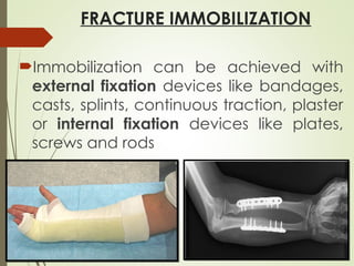 FRACTURE IMMOBILIZATION
Immobilization can be achieved with
external fixation devices like bandages,
casts, splints, continuous traction, plaster
or internal fixation devices like plates,
screws and rods
 