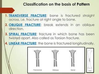 1. TRANSVERSE FRACTURE: bone is fractured straight
across, i.e. fracture at right angle to bone.
2. OBLIQUE FRACTURE: break extends in an oblique
direction.
3. SPIRAL FRACTURE: fracture in which bone has been
twisted apart. Also called as Torsion fracture.
4. LINEAR FRACTURE: the bone is fractured longitudinally.
Classification on the basis of Pattern
 