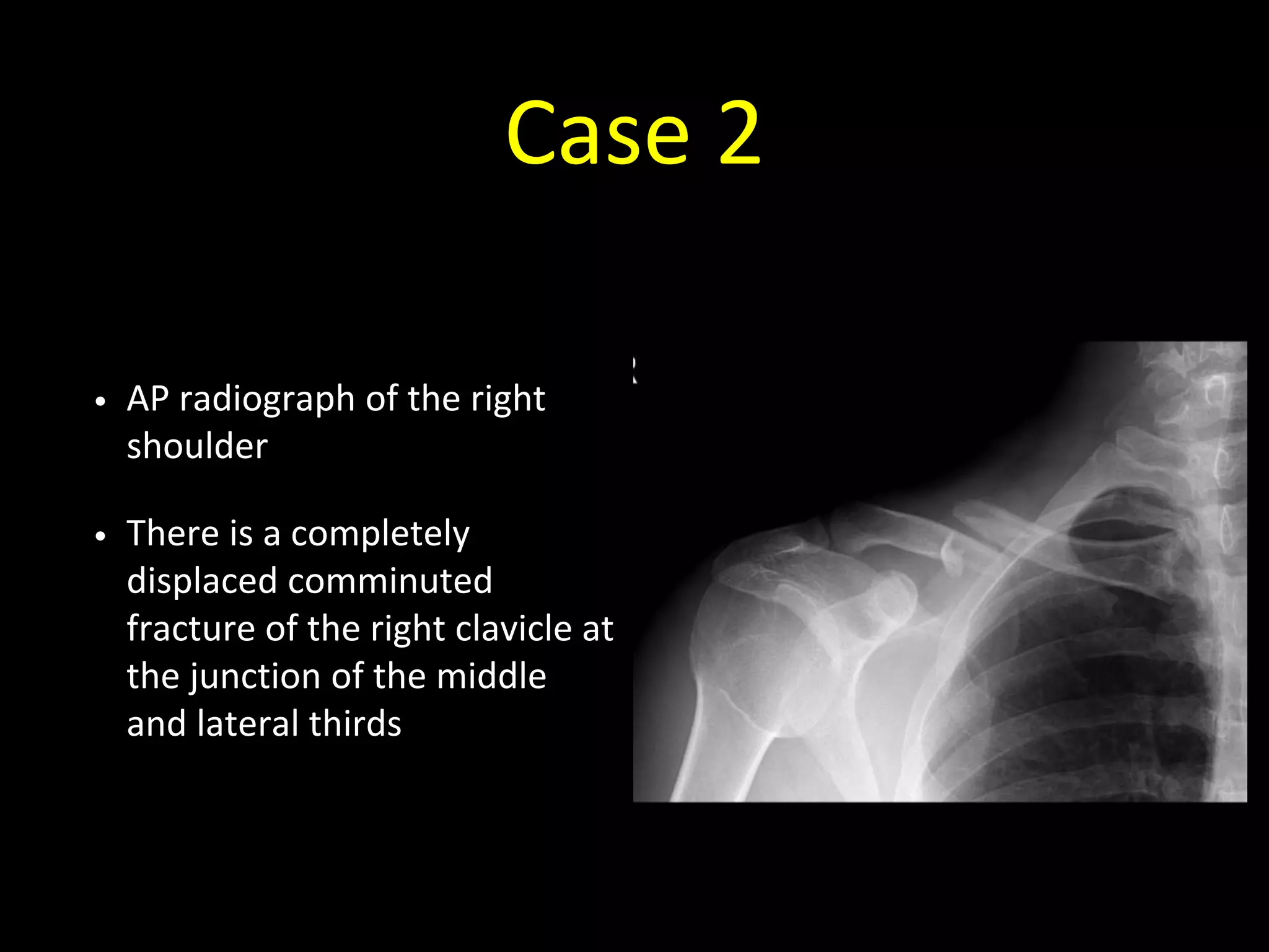 Case 2
• AP radiograph of the right
shoulder
• There is a completely
displaced comminuted
fracture of the right clavicle at
the junction of the middle
and lateral thirds
 